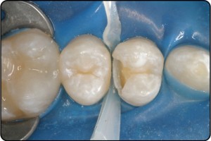 Izolacija zob z gumijasto opno preprečuje kontaminacijo delovnega polja s slino in omogoča večjo udobnost pacientu