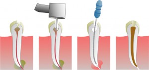 Endodontsko zdravljenje zoba